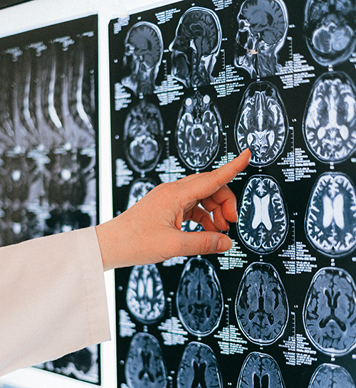 doctor pointing to xray images of a brain