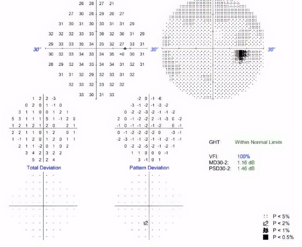 Humphrey visual field (HVF) results