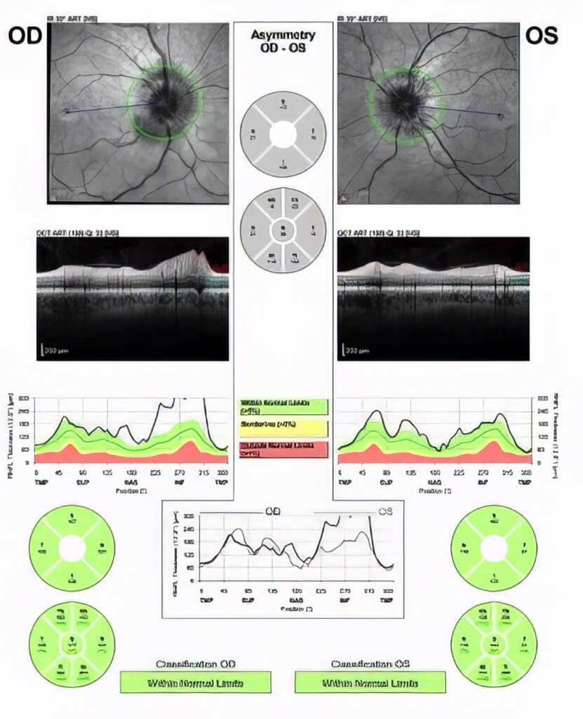 Spectral Domain Optical coherence tomography